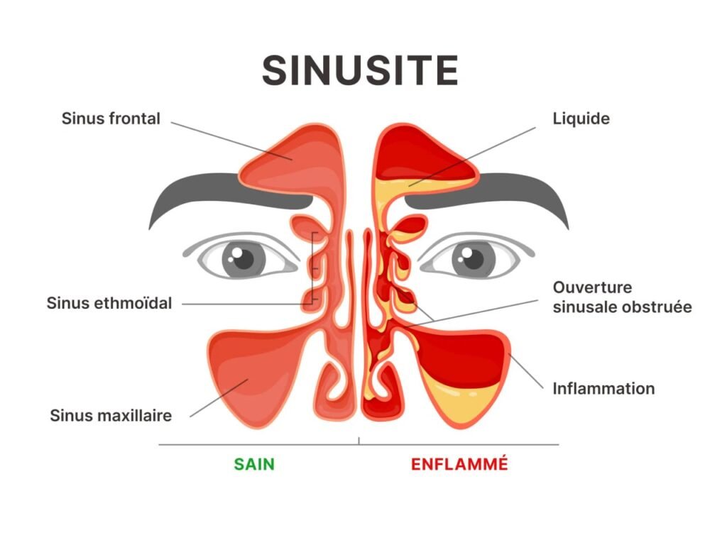 La sinusite whatsapp image 2026 01 05 at 13.16.02